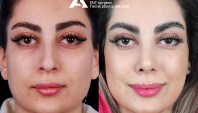 rhinoplasty-befor-after-1-1024x683 1